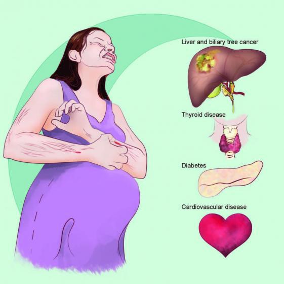 joh:妊娠期肝内胆汁淤积症女性后来发生肝癌和其他疾病的风险高