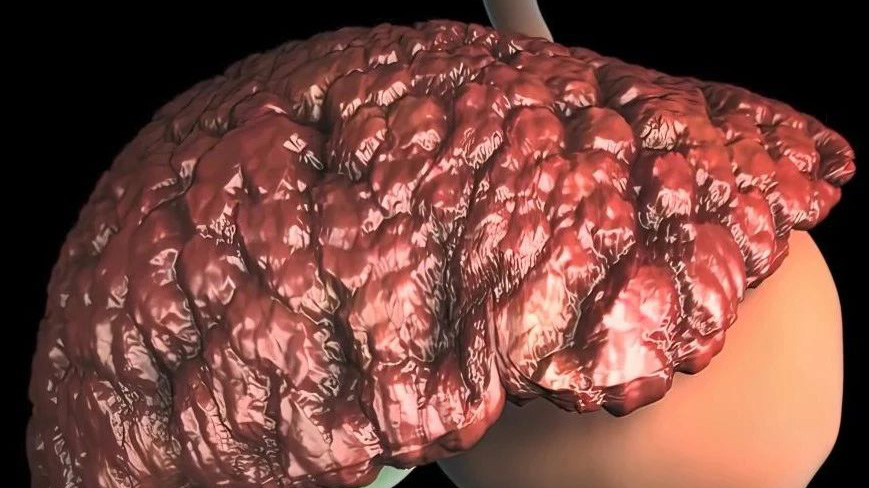 人工肝支持系统可改善慢加急性肝衰竭患者肠道菌群和血清胆汁酸